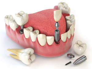Zahnersatz auf Zahnimplantaten